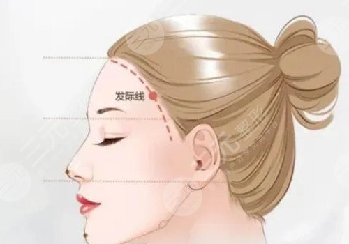 發(fā)際線移植能保持多久？