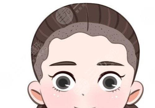 發(fā)際線移植能保持多久？