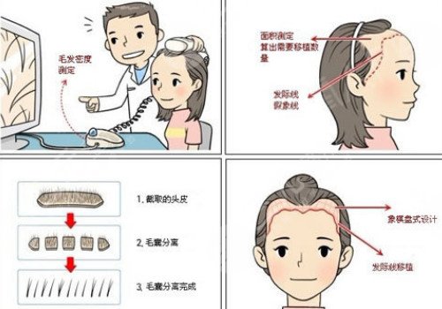 發(fā)際線移植能保持多久？