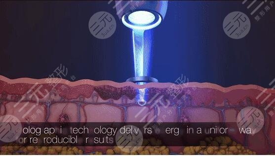 激光美白的價(jià)格是多少?