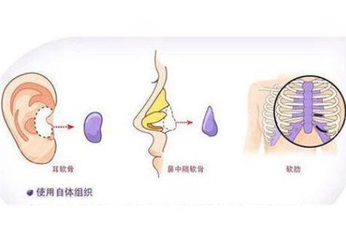 自體軟骨隆鼻多少錢？
