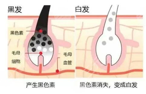 長(zhǎng)白頭發(fā)了是什么原因?qū)е碌?