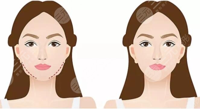 咬肌大怎么辦怎么改良快速又有？