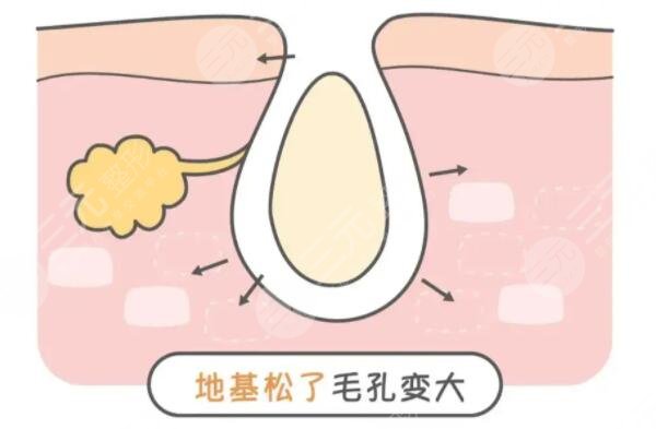 怎么收縮面部毛孔有又快速？文中3中方法你得學(xué)起來！如何預(yù)防是關(guān)鍵！