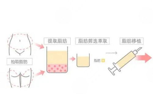 面部自體脂肪填充可以維持多久？