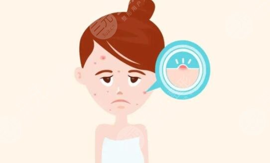 北京緩解痤瘡多少錢一個(gè)療程?