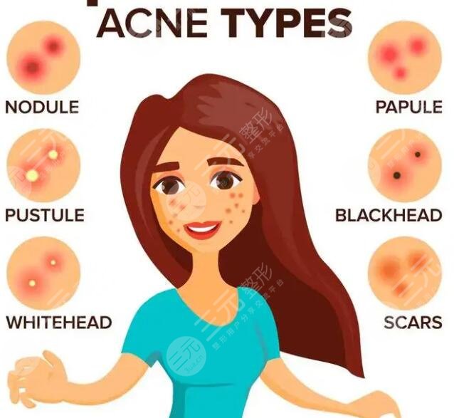 北京緩解痤瘡影響因素