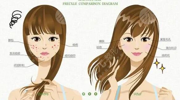 緩解痤瘡的方法