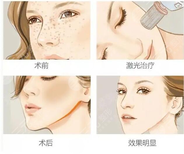 光子嫩膚適用皮膚范圍