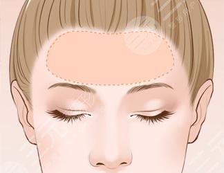 面部自體脂肪填充可以維持多久？