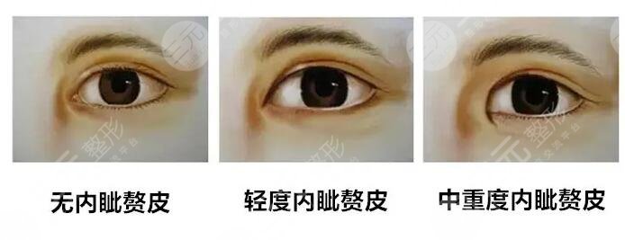 開內(nèi)眼角的手術(shù)有哪些?