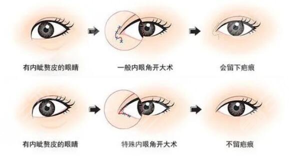 開內(nèi)眼角手術(shù)價格