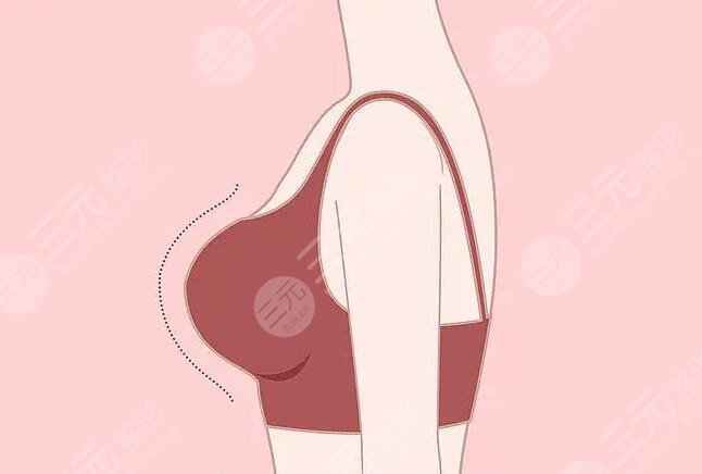 豐胸方法有哪些?