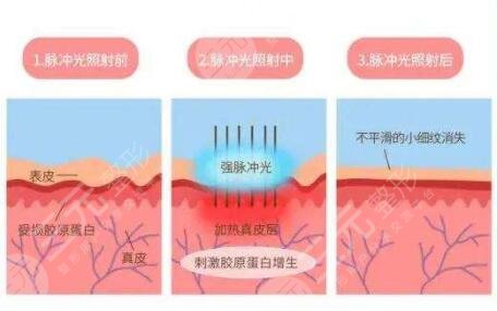 復(fù)合彩光去紅血絲的案例介紹