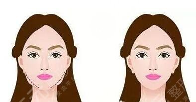 下頜角肥大矯正術(shù)術(shù)后并發(fā)癥有哪些？