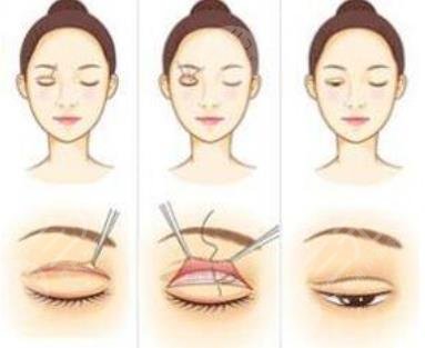 雙眼皮修復
