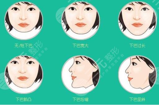 膨體隆下巴的術后護理