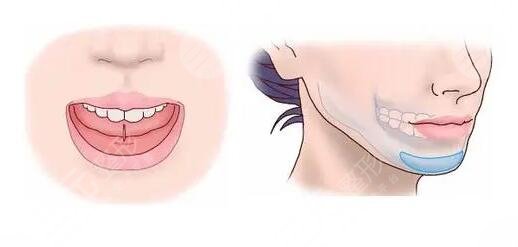 隆下巴假體恢復(fù)過(guò)程圖整理！隆下巴的手術(shù)過(guò)程是怎樣的？注意事項(xiàng)有哪些？