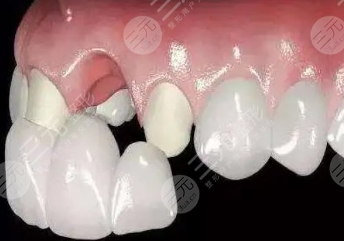 滿口烤瓷牙要多少錢?