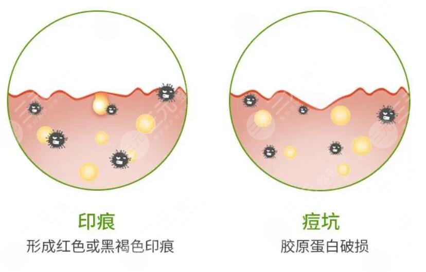 復合彩光祛痘的案例介紹