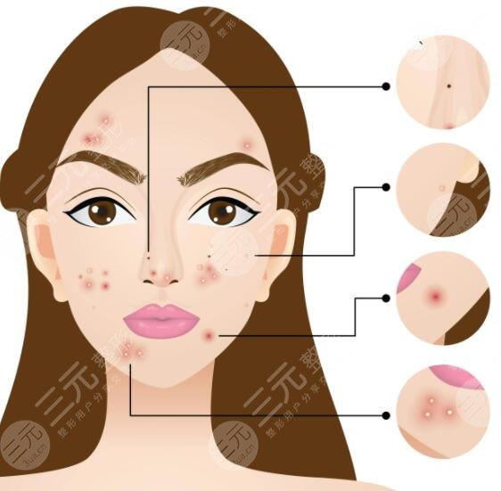 復合彩光祛痘的案例介紹