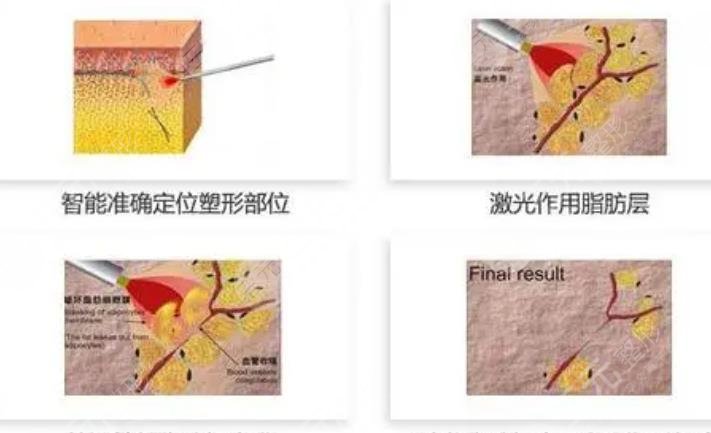 等離子激光溶脂