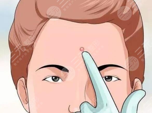 祛痘印的有方法有哪些?