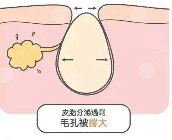 什么醫(yī)美項目收縮毛孔果好？近幾年爆款醫(yī)美項目云集，總有一款適合你~