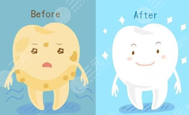 beyond冷光牙齒美白果好嗎?