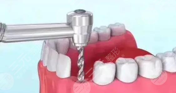 種植牙