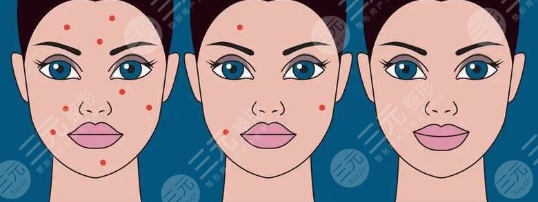 復(fù)合彩光祛痘的原理是什么?