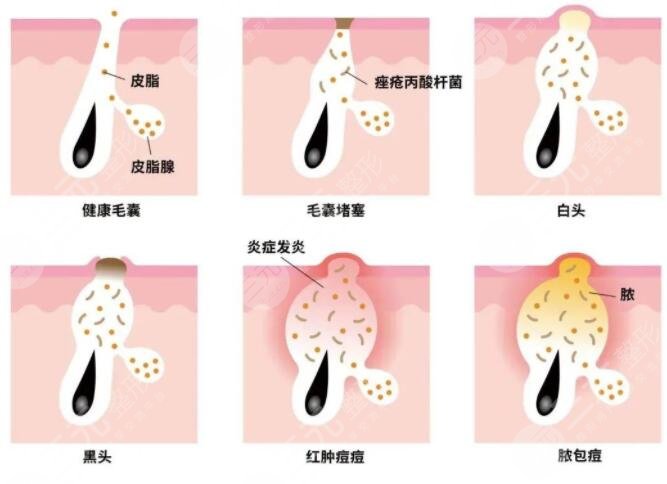 復(fù)合彩光祛痘需要多少錢(qián)?