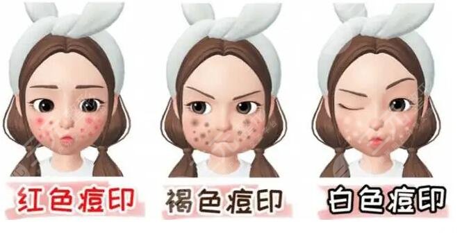 復(fù)合彩光祛痘需要多少錢(qián)?