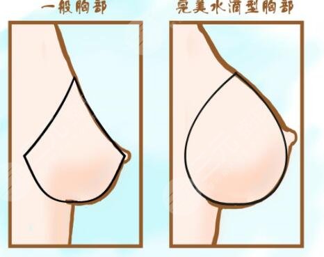 英國(guó)娜高假體的優(yōu)勢(shì)性