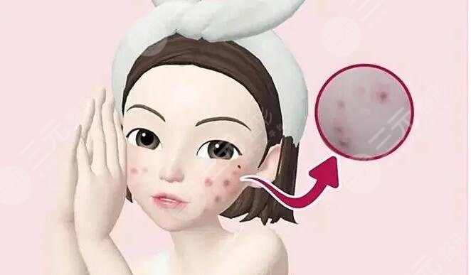 痤瘡緩解之后需要注意什么?