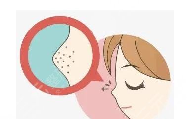 黑頭導(dǎo)出液真的有用嗎?