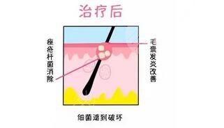 紅光緩解痤瘡幾次見?