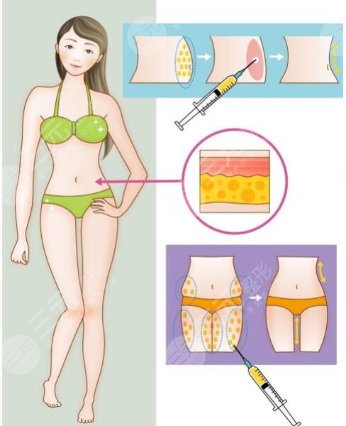 等離子激光溶脂有危害嗎？對身體有傷害嗎？副作用是什么？怎么果？