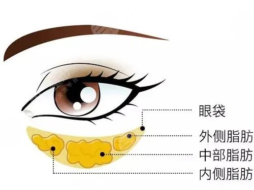 怎么去眼袋快有？