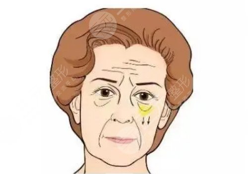 怎么去眼袋快有？