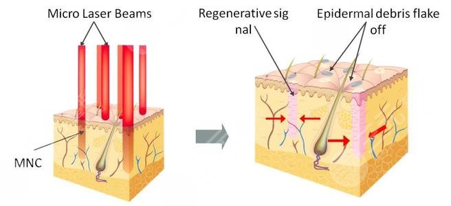 如何消除青春痘疤痕?痘印?