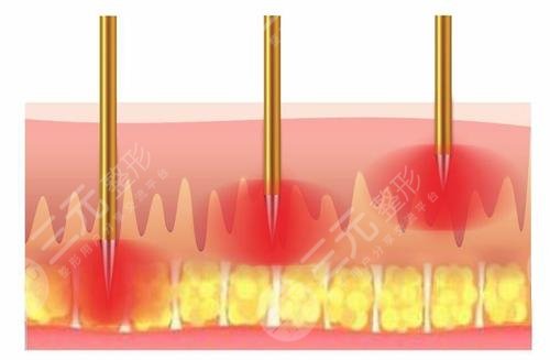 去紅痘印術(shù)前要準備什么工作?