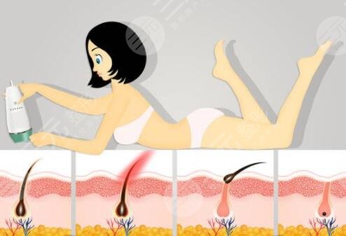 做脫毛的次數(shù)不同價(jià)格也就不同