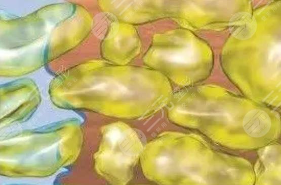 水動(dòng)力吸脂