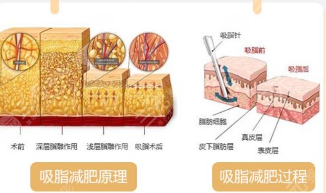 水動(dòng)力吸脂