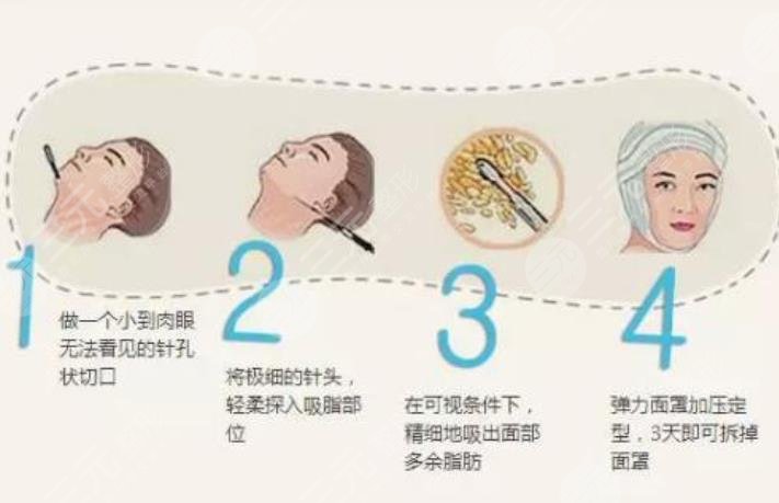 面部吸脂