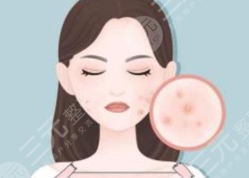 長(zhǎng)痤瘡