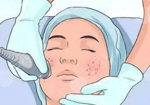 怎樣祛斑果好些?