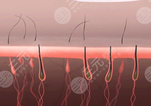 shr冰點脫毛價格影響因素
