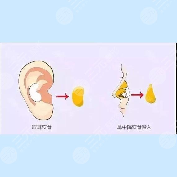 自體軟骨隆鼻多少錢?